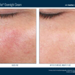 Skinbetter AlphaRet Overnight Cream Before and After