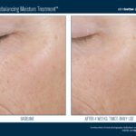 Skinbetter Trio Rebalancing Moisture Treatment Before and After 3