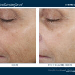 Skinbetter Even Tone Correcting Serum Before and After 1