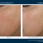 Skinbetter Even Tone Correcting Serum Before and After2