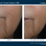 Skinbetter InterFuse Intensive Treatment LINES Before and After 1