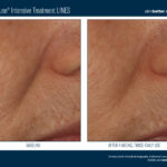 Skinbetter InterFuse Intensive Treatment LINES Before and After 2