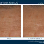 Skinbetter InterFuse Intensive Treatment LINES Before and After 3