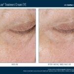 Skinbetter InterFuse Treatment Cream EYE Before and After 2